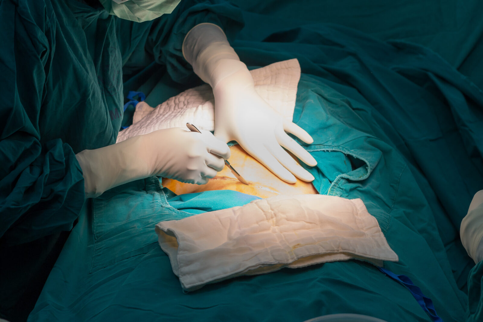 Close-up view of a cesarean section surgery in progress. Two gloved hands of medical professionals are visible working on a patient lying on an operating table. The patient is covered with teal surgical drapes, and surgical gauze pads are present in the surgical field. The image shows the medical reality of cesarean births that are being debated in Turkey